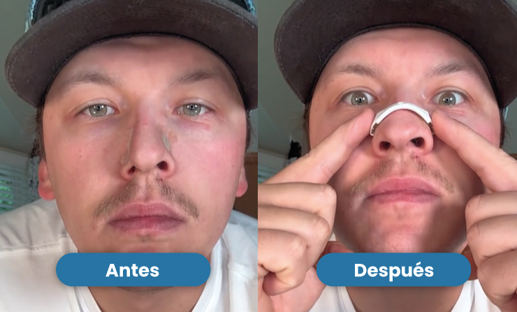 Tiras Nasais: Como funcionam?